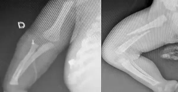 Pai é preso após bebê de seis meses ser socorrido com fraturas nos braços, costela e fêmur em Limeira. — Foto: Divulgação/Guarda Civil Municipal de Limeira